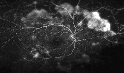 This image shows the blood vessels in the retina of a patient with  proliferative diabetic retinopathy.
