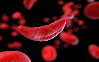 anemia falciforme