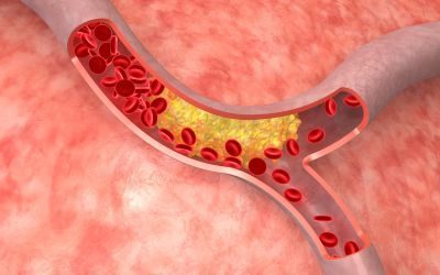 terapie a RNA, colesterolo, RNA interference