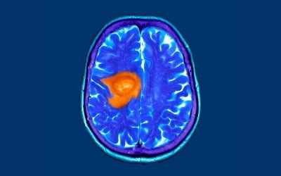 glioblastoma