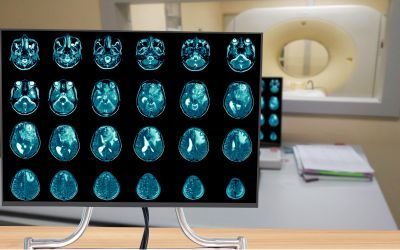glioblastoma, vaccini a mRNA, RNA therapies
