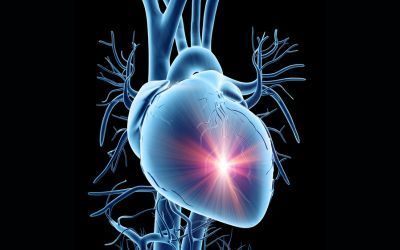 infarto