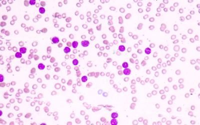 CAR-T, brexucabtagene autoleucel, leucemia linfoblastica acuta