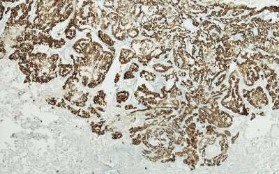 Micrografia di mesotelioma pleurico