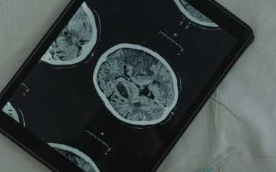 Neuroblastoma