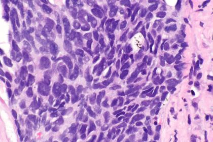 CRISPR per curare il tumore? 