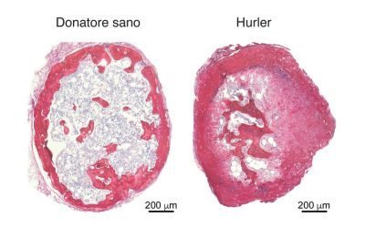organoide, sindrome di Hurler, mucopolisaccaridosi