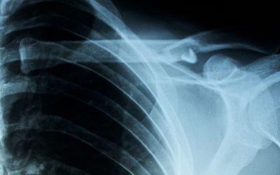 osteogenesi imperfetta, crispr, editing genomico