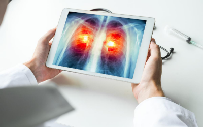 Terapie digitali per tumore al polmone