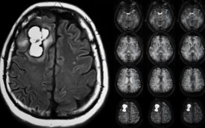 tumore al cervello, car-t, tumore pediatrico